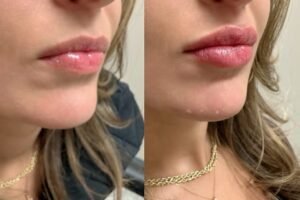 lip-filler-after-2-weeks-CLIENT-1024×1024