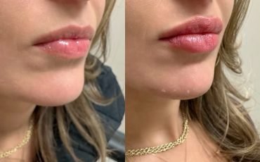 lip-filler-after-2-weeks-CLIENT-1024x1024